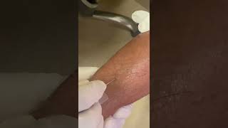 IV cannula insertiondoctertrendingshortvideoviralvideo [upl. by Htebi]