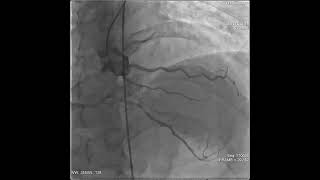 Coronary angiogram shows a large dominant right coronary artery [upl. by Vtehsta]