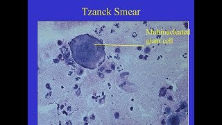 Tzanck smear Positive [upl. by Matty]