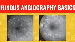 FFA course  FUNDUS FLUORESCEIN ANGIOGRAPHY [upl. by Lasorella128]