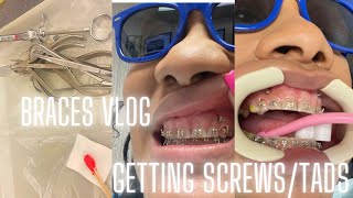 BRACES VLOG  GETTING SCREWS TADS MINI IMPLANTS [upl. by Enneite388]