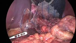 Laparoscopic repair of giant hiatus hernia with composite mesh [upl. by Shanleigh445]