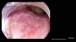 Oropharyngeal Cancer Posterior Wall [upl. by Nortal988]