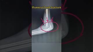 Humerus Bone Fracture medicalimaging [upl. by Chace]