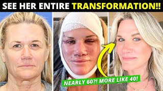 Facelift at Nearly 60 Changes Her Entire Life Dramatic Vertical Restore Surgery BeforeAfter [upl. by Goebel694]