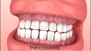 What is Pericoronitis When is Operculectomy Brace Dental Clinics [upl. by Augustus167]