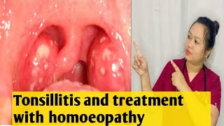 Tonsillitis😱😱signs amp symptoms and its treatment with homoeopathy ✅🍀💯 [upl. by Amaryl]