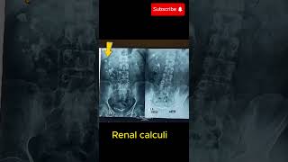 Intravenous urography IVU showing hydronephrosis amp renal calculihydronephrosis renalcalculi [upl. by Eisen]