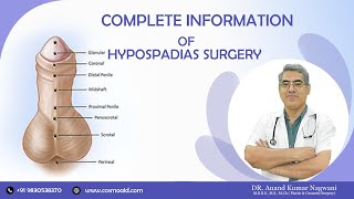 Hypospadias Surgery  Complete Information of Hypospadias Problem amp Solution  By Dr A K Nagwani [upl. by Nylhtak]