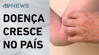 Brasil ultrapassa mil casos de Mpox em 2024 [upl. by Aikkin777]