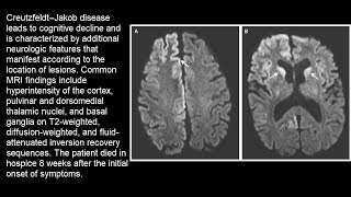 Creutzfeldt–Jakob Erkrankung [upl. by Jodoin]