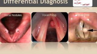 Vocal nodules Inservice [upl. by Adama]