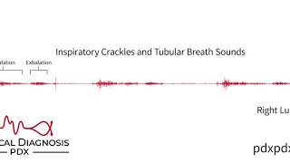 The Lung Sounds of Pneumonia [upl. by Haropizt888]