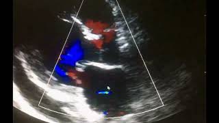 Ecocardiograma Complicaciones del Infarto al miocardio [upl. by Odlavso126]