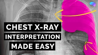 Chest Xray Interpretation  How to Read a CXR  OSCE Guide  UKMLA  CPSA [upl. by Englis]