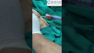 Post trauma PrePatellar Bursitis Aspiration  Dr Syed Nazeeb Ulla [upl. by Tterrab204]