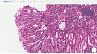 PeutzJeghers Polyp  Histopathology [upl. by Reynold681]