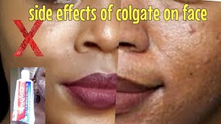 I Applied Colgate On My Face And This HappenedIT BURNS [upl. by Messing]