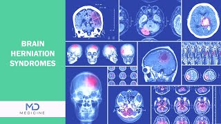 Brain Herniation syndromes Types Symptoms and Treatment [upl. by Ahsaele]