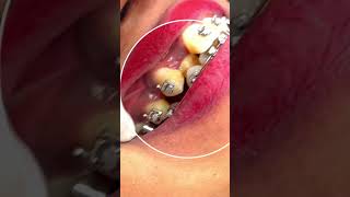 Making Space for Lateral Incisors  Orthodontic Insights dentist shorts [upl. by Karlise]