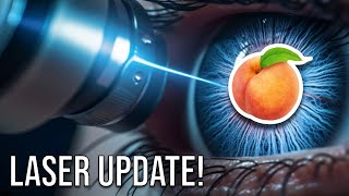 LASER Surgery Update  Hemorrhoids Anal Fistula Pilonidal Cyst [upl. by Mallory811]