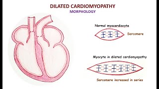 Dilated cardiomyopathy [upl. by Godspeed]