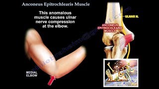 Anconeus Epitrochlearis Muscle cubital tunnel  Everything You Need To Know  Dr Nabil Ebraheim [upl. by Coop]