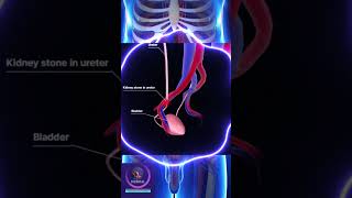 Kidney Stone In The Ureter shorts education [upl. by Nodyroc202]