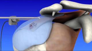 Shoulder Arthroscopy [upl. by Aratahc]