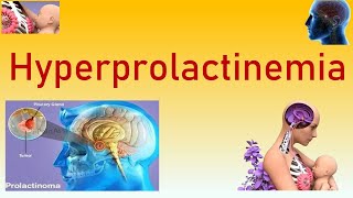 Can I get Pregnant with HIGH PROLACTINHIGH PROLACTIN amp INFERTILITYDrSneha ShettyDoctors Circle [upl. by Odrude]