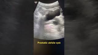 Prostatic utricle cyst prostatetrasound radiology radiography ultrasoundmadeeasy [upl. by Nessaj]