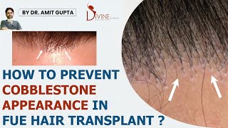 How to Prevent Cobblestone Appearance in FUE Hair Transplant [upl. by Yht]