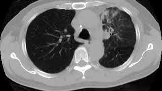 Lymphangitis carcinomatosis Ahuja AT et al 2017 Book Essential Radiology [upl. by Paris]