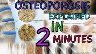 OSTEOPOROSIS  EXPLAINED IN 2 MINUTES  CAUSES  SYMPTOMS  TREATMENT  WHAT IS OSTEOPOROSIS [upl. by Mozes]