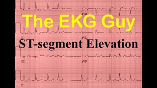 EKGECG STsegment Elevation  Question 90  The EKG Guy [upl. by Ahtera]