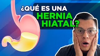 ¿QUÉ ES UNA HERNIA HIATAL [upl. by Llednek]