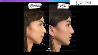 How to choose the best filler Juvederm vs Radiesse  Wave Plastic Surgery [upl. by Barmen]