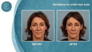 Undereye filler with Restylane Dr Palm San Diego [upl. by Enaed]