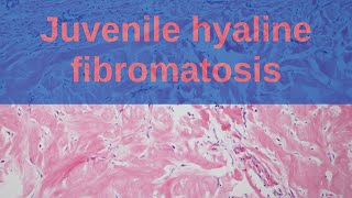 Juvenile Hyaline Fibromatosis  Pathology mini tutorials [upl. by Kiki]