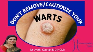 Dont Remove or Cauterize your warts [upl. by Gnoc]