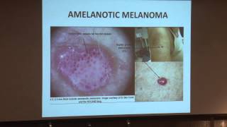 Not Your Typical Melanoma Clinical Clues and Pitfalls [upl. by Etnohs]