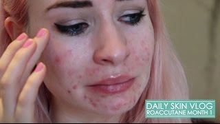 Roaccutane Daily Skin Vlog  Month 1 [upl. by Eirdua]