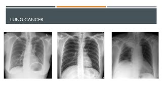 Chest Xray in Lung cancer part 1 cxr cancer radiology [upl. by Profant85]