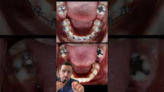 CLINIQUE  traitement Orthodontie molaires dentaire [upl. by Llenrad]