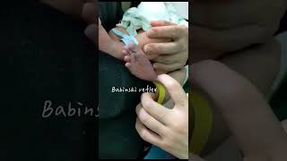 Babinski reflex in infants [upl. by Shevlo]