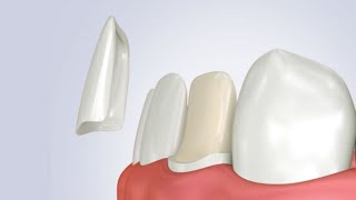 Cementazione faccetta dentale in disilicato di litio step by step [upl. by Arreit]