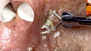 How To Remove Blackheads in the Forehead Easy [upl. by Urbannai]