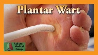 Plantar Wart Treatment  Auburn Medical Group [upl. by Issak393]