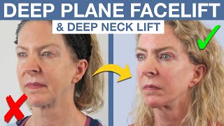 She Looks 20 Years Younger Deep Plane Facelift Before amp After [upl. by Gehlbach]