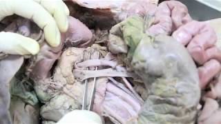 Anatomy Dissection of Pancreas amp Duodenum [upl. by Nalyt]